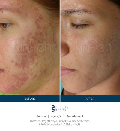 acne-scars-microneedling-v2-400x436