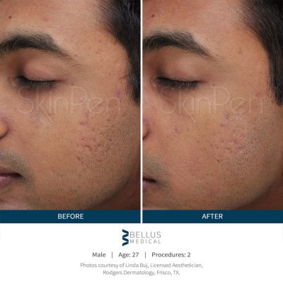 skinpen-male-before-after-1-800x810-2-400x405
